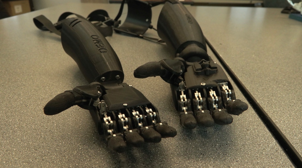 The prosthetic arms are able to open and close through shoulder movements. (CTV)